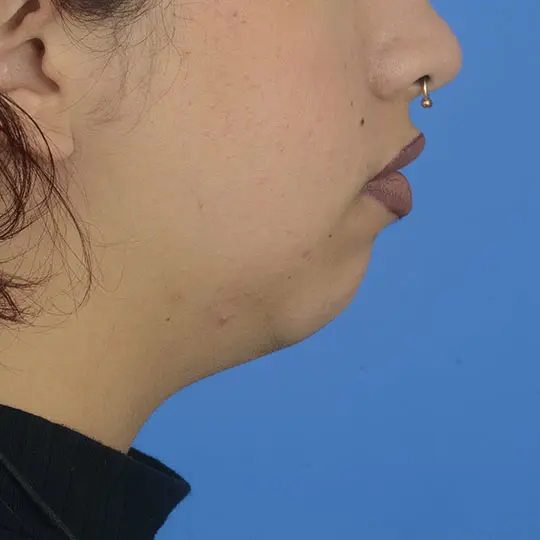 Patient Before & After Photo