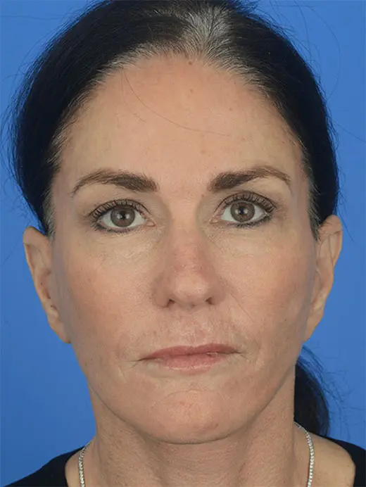 88278 endoscopic brow lift, face, and neck lift. Front view post op