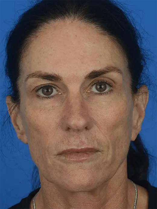 88278 endoscopic brow lift, face, and neck lift. Front view pre op