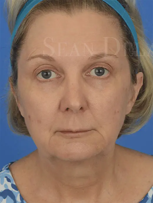 93555  facelift, brow lift, facial fat transfer, lip lift and facial fat transfer. Front view pre op