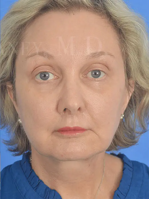 93555  facelift, brow lift, facial fat transfer, lip lift and facial fat transfer. Front view post op
