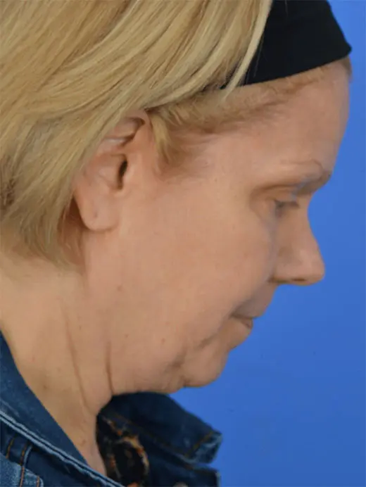 Neck Lift Neck Liposuction 96242 Profile View, chin tuck, Pre Op