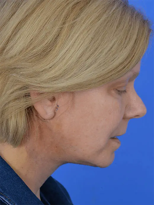 Neck Lift Neck Liposuction 96242 Profile View, chin tuck, Post Op