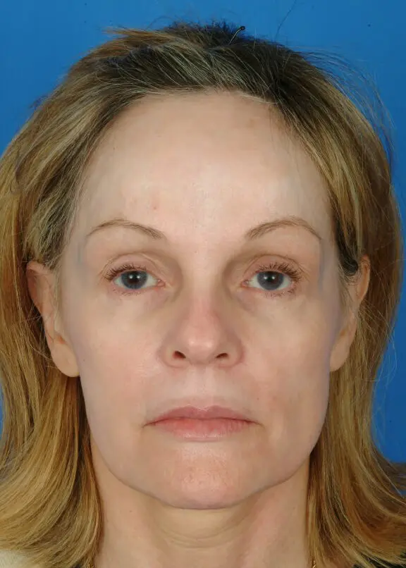 Patient Before & After Photo