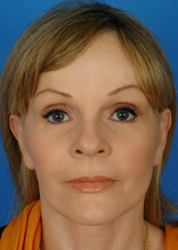 Patient Before & After Photo