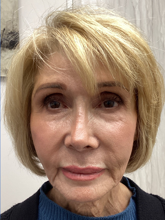 Patient Before & After Photo