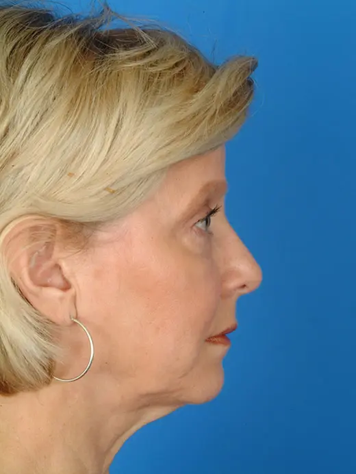 Facelift and Eyelid Surgery. 2960 profile view pre op