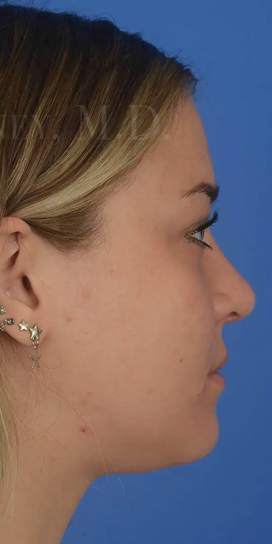 Primary-Rhinoplasty-for-hump-reduction-and-tip-elevation-in-Houston--TX | After Rhinoplasty