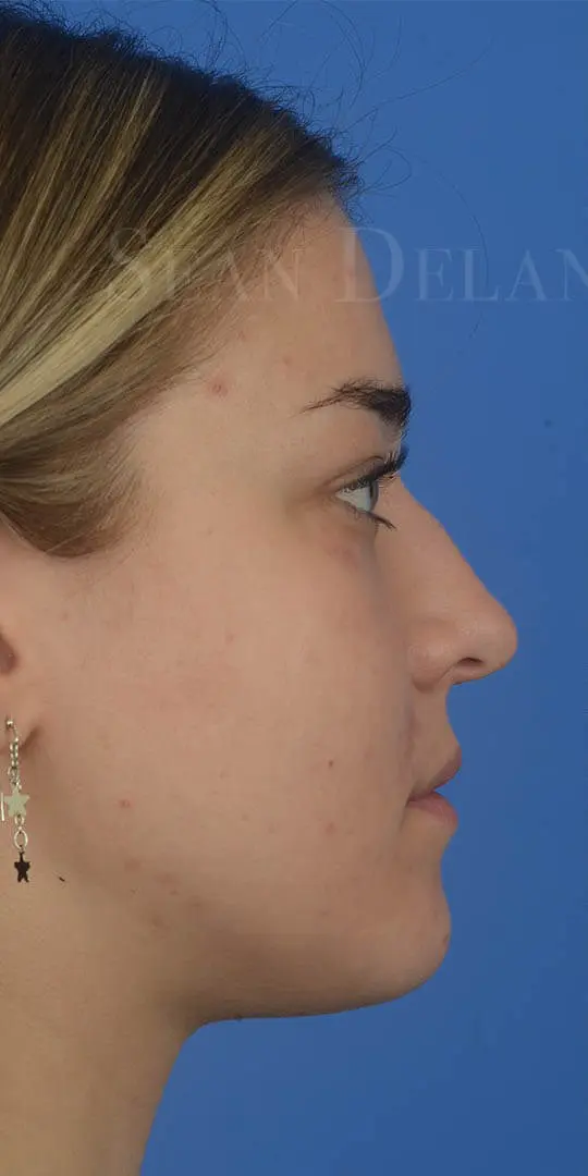 Primary-Rhinoplasty-for-hump-reduction-and-tip-elevation-in-Houston--TX | Before Rhinoplasty