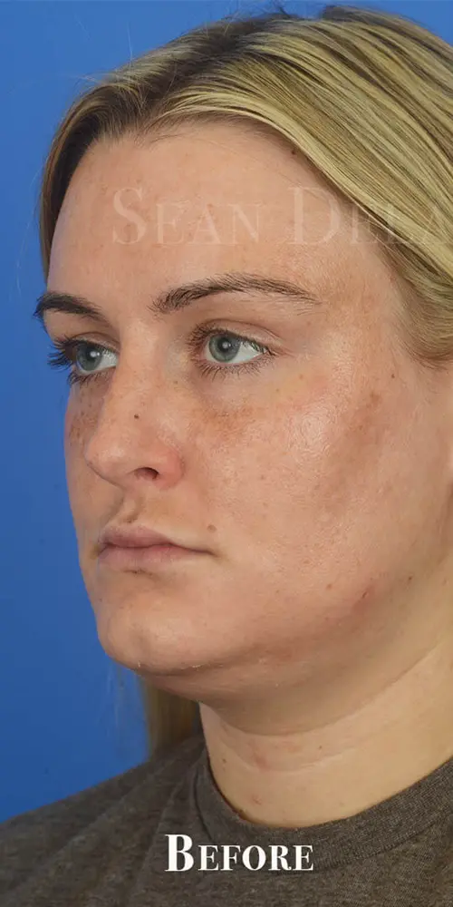 Chin Liposuction 85220 Oblique View Pre Op