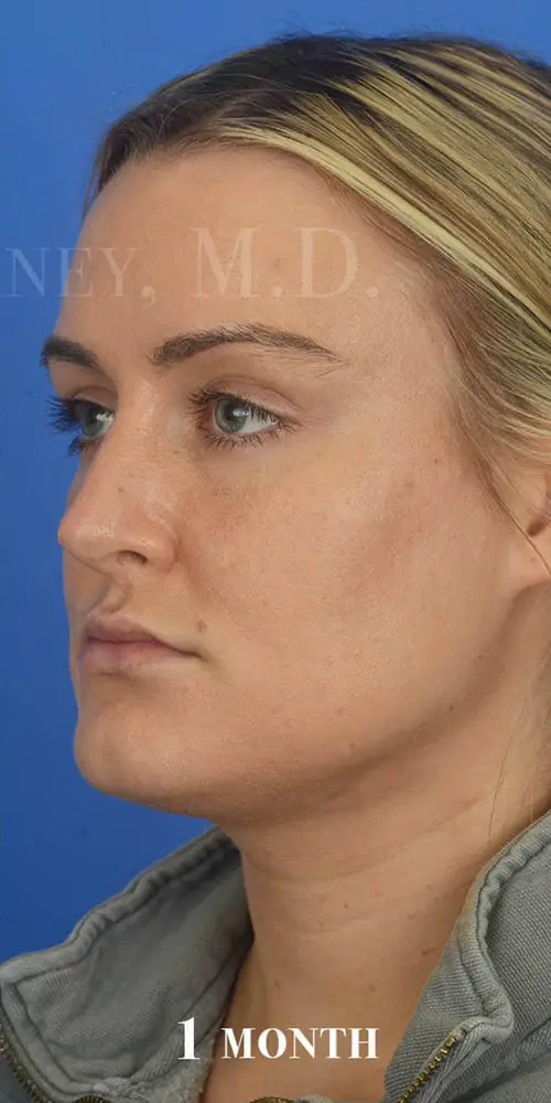Chin Liposuction 85220 Oblique View Post Op