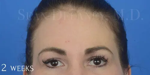Laser Skin Resurfacing Facial Wrinkles CO2 Laser 85238 After Treatment