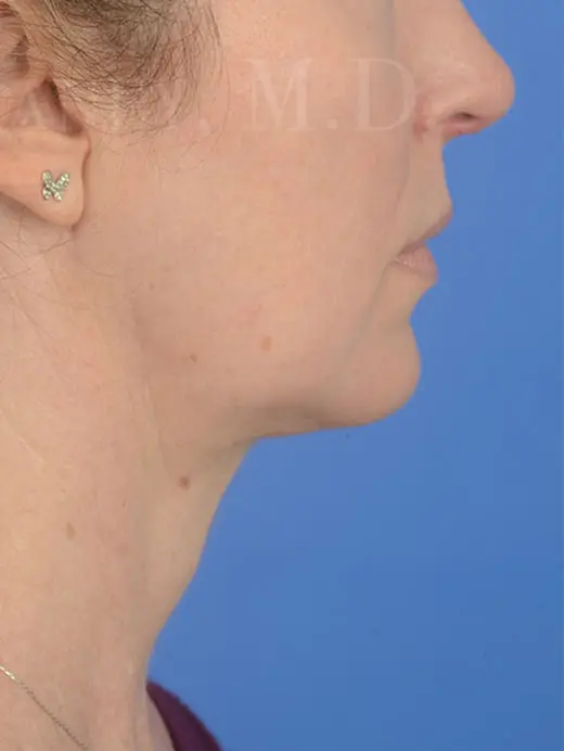 Patient Before & After Photo