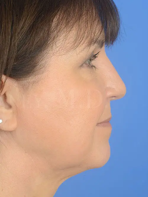 86257 Rhinoplasty Post