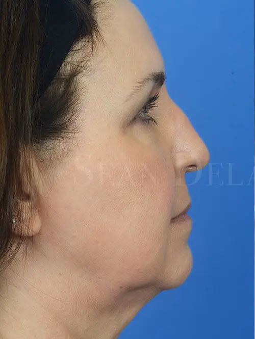 86257 Rhinoplasty Pre