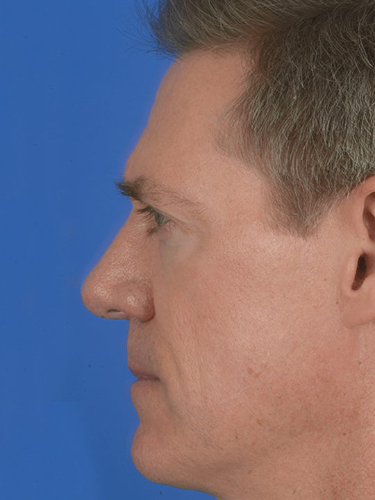 Combined-functional-and-cosmetic-Rhinoplasty-to-correct-a-crooked-nose | After Rhinoplasty