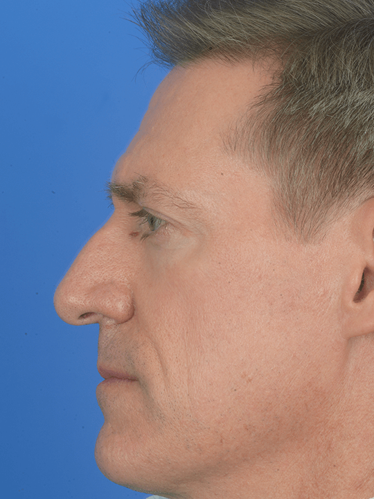 Combined-functional-and-cosmetic-Rhinoplasty-to-correct-a-crooked-nose | Before Rhinoplasty