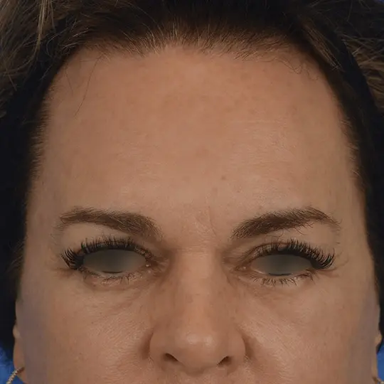 Brow Lift Eyelid Surgery Forehead Lift Lower Eyelid Surgery Upper Eyelid Surgery 89133 Post Op