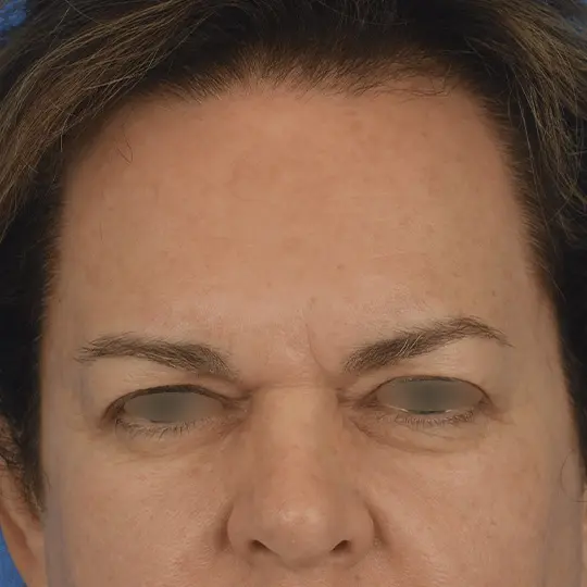 Brow Lift Eyelid Surgery Forehead Lift Lower Eyelid Surgery Upper Eyelid Surgery 89133 Pre Op