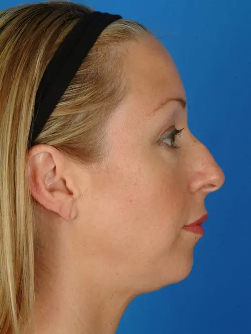 Rhinoplasty  and Chin Augmentation 11687 Profile View Before 