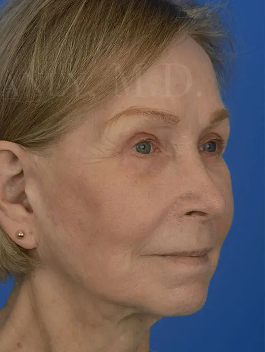 Patient Before & After Photo