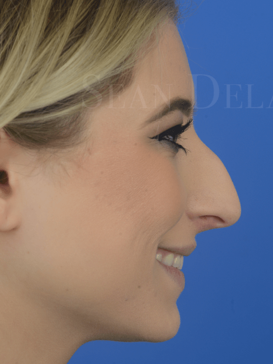 Primary-Rhinoplasty-to-make-the-nose-smaller-in-Houston--TX | Before Laser Skin Resurfacing