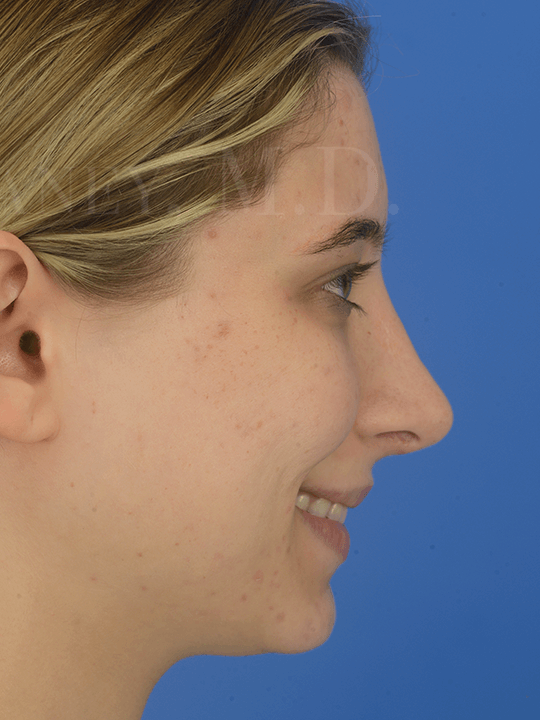 Primary-Rhinoplasty-to-make-the-nose-smaller-in-Houston--TX | After Laser Skin Resurfacing