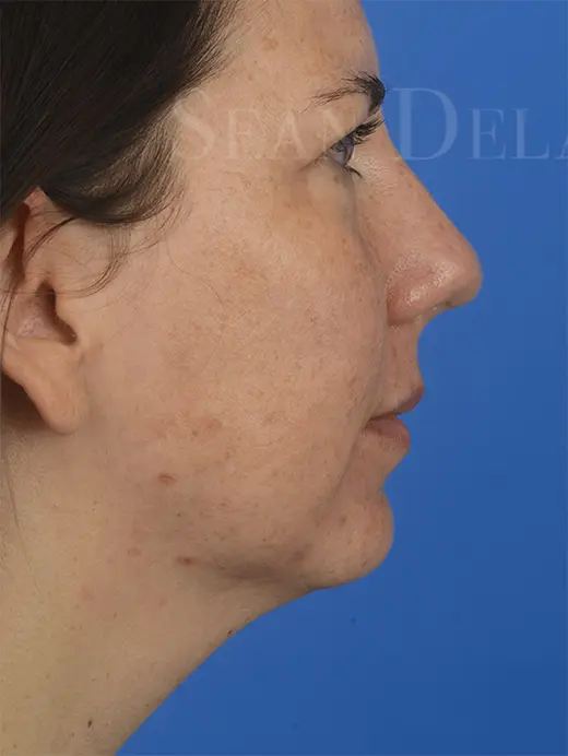 Submental Liposuction Chin Augmentation Neck Liposuction 85204 Profile View Pre Op