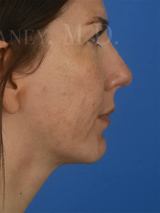 Submental Liposuction Chin Augmentation Neck Liposuction 85204 Profile View Post Op