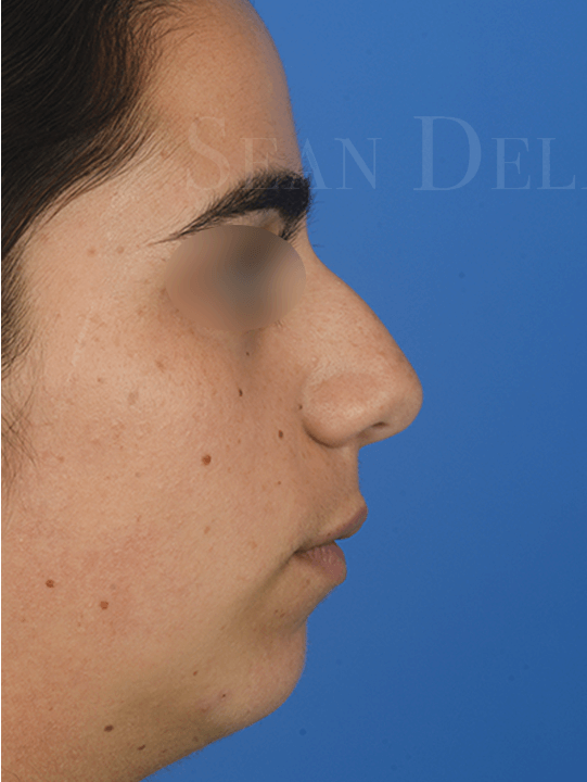 Thick-skin-rhinoplasty-to-improve-breathing-and-reduce-nasal-size-in-Houston | Before Chin Augmentation