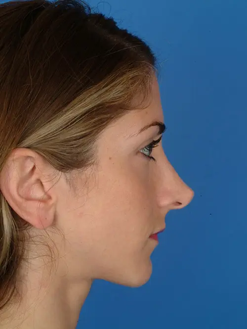 Revision rhinoplasty 2936 Profile View Pre Op