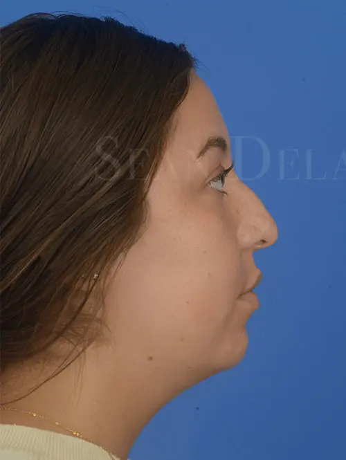 Profile-makeover-with-teenage-rhinoplasty-and-chin-implant-in-Houston--TX | Before Rhinophyma