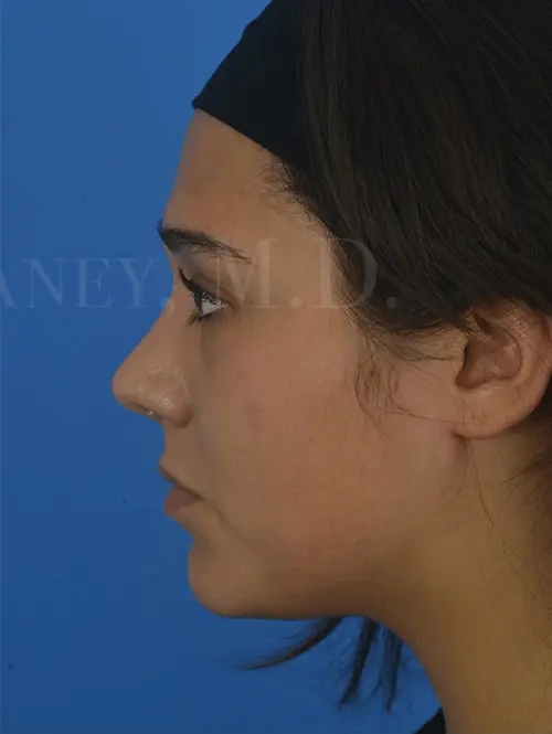 Rhinoplasty-and-Septal-harvest-for-grafts-to-reshape-nose | After Rhinophyma