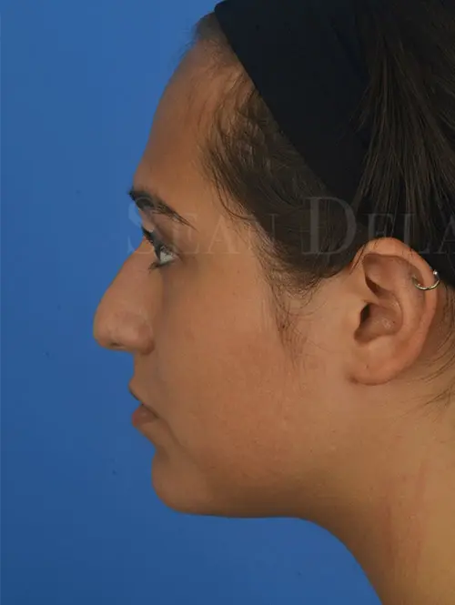 Rhinoplasty-and-Septal-harvest-for-grafts-to-reshape-nose | Before Rhinophyma