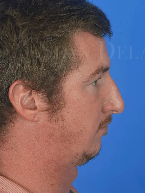 Profile-rebalancing-with-rhinoplasty-and-chin-augmentation-for-Houston-Male | Before Ear Surgery (Otoplasty)