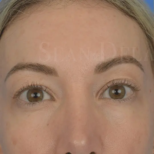 93565 Upper Blepharoplasty Eyes close up pre op