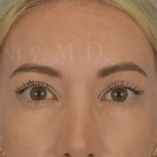 93565 Upper Blepharoplasty Eyes close up post op
