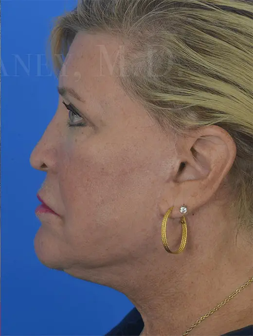 Neck Lift Eyelid Surgery Facelift 93574 Profile View Post Op