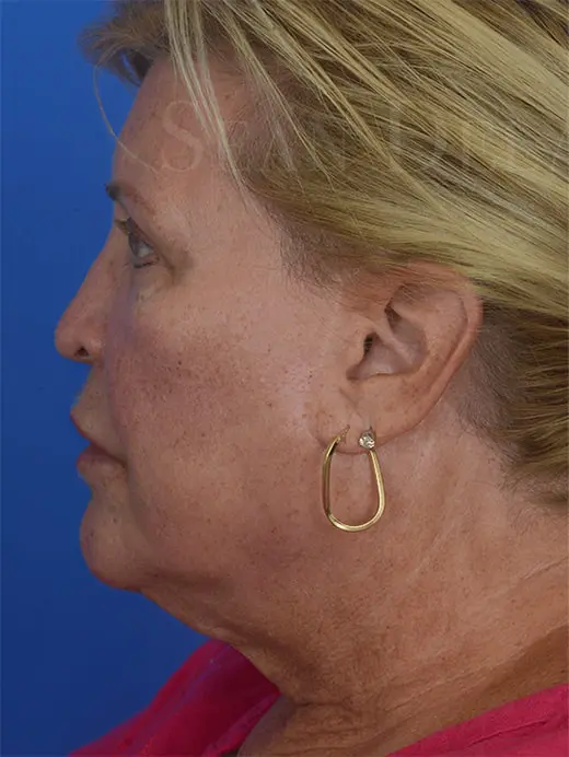 Neck Lift Eyelid Surgery Facelift 93574 Profile View Pre Op