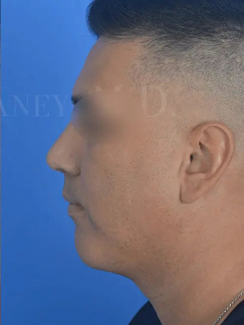 Rhinoplasty-and-lower-face-sculpting-for-adult-male-in-Houston | After Facelift