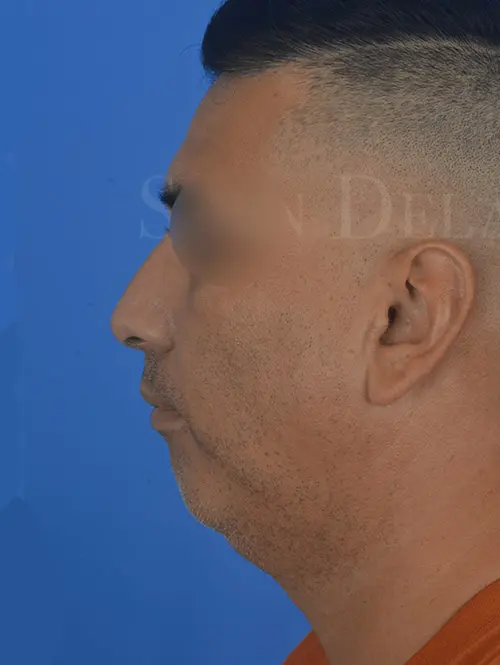Rhinoplasty-and-lower-face-sculpting-for-adult-male-in-Houston | Before Facelift