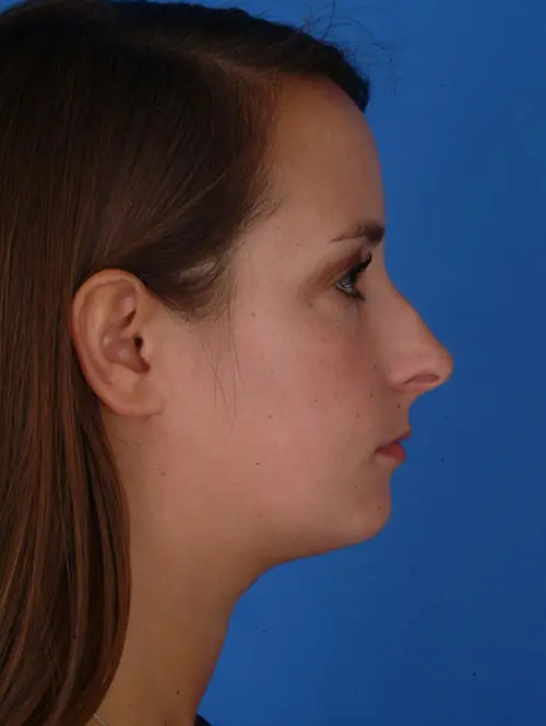 Rhinoplasty and chin augmentation 23913 Before profile view