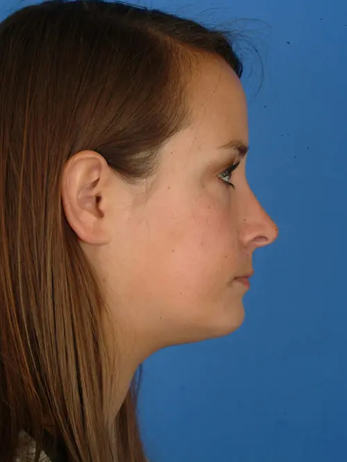 Rhinoplasty and chin augmentation 23913 after profile view