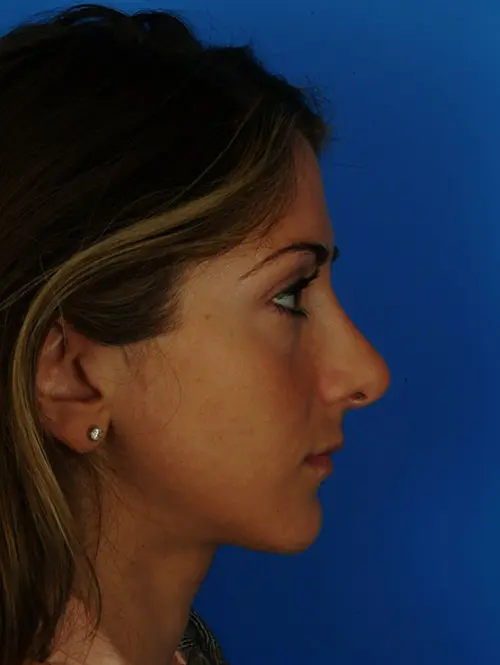 Revision rhinoplasty 2936 Profile View 4 months post Op