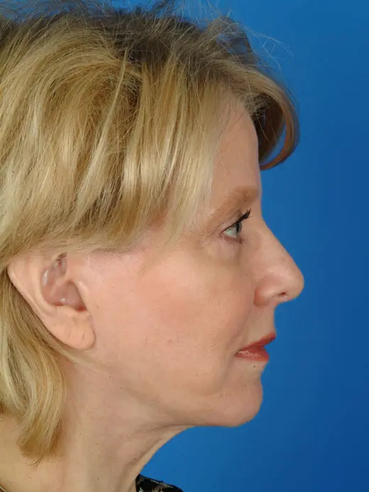 Facelift and Eyelid Surgery. 2960 profile view 1 yr 2 month post-op