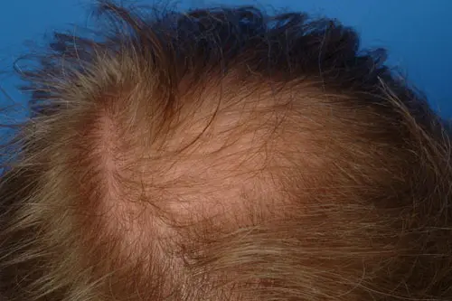 Hair Restoration Before Treatment