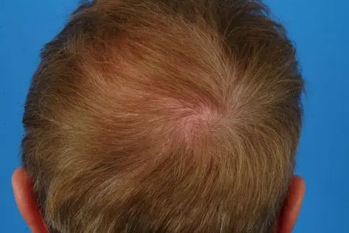 Hair Restoration After Treatment