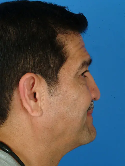 Nasal and eyelid surgery 7390 profile view pre op