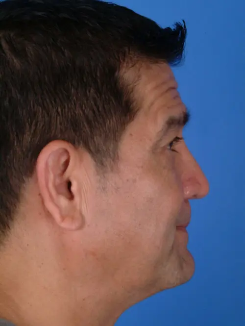 Nasal and eyelid surgery 7390 profile view post op