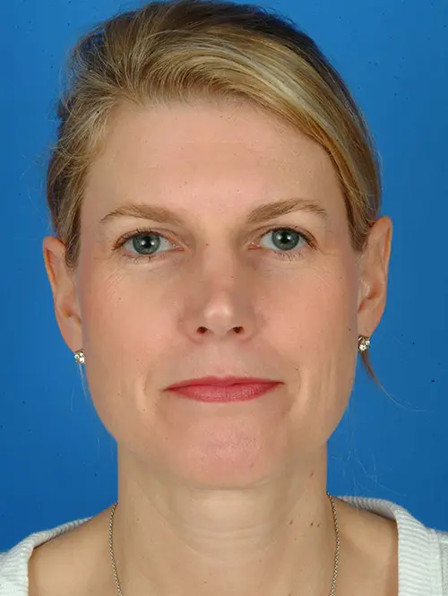 revision rhinoplasty 7395 pre op